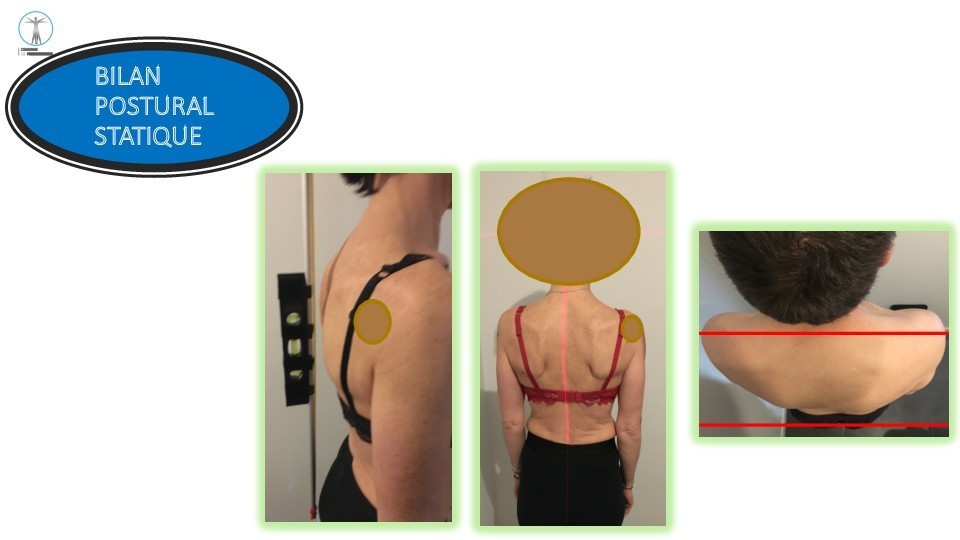 Bilan postural